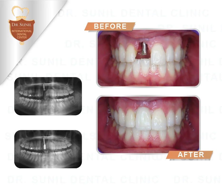 Teeth implant Clinic in Thailand